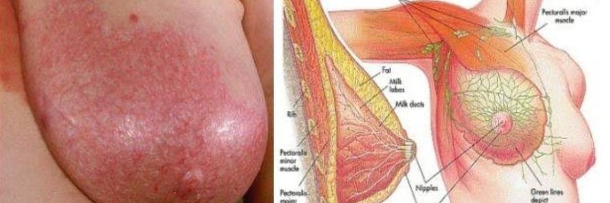 Breast abscess treatment and breast health care services at Curepath Health Solution