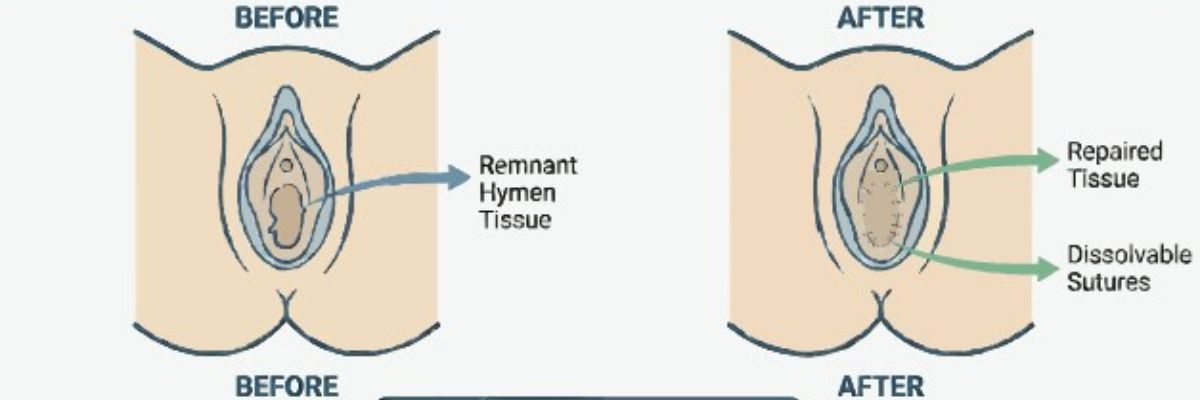Hymenoplasty procedure and confidential women’s health consultation at Curepath Health Solution