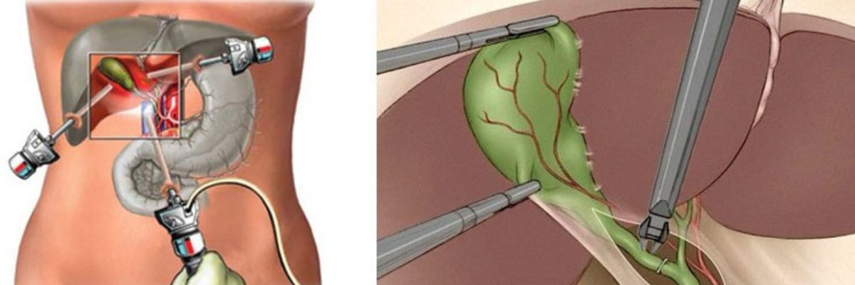 Gallstone symptoms, diagnosis and treatment consultation at Curepath Health Solution