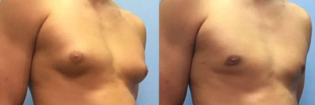 Gynecomastia treatment and male breast reduction surgery services by CurePath Health Solution for men experiencing enlarged breast tissue and related cosmetic concerns.