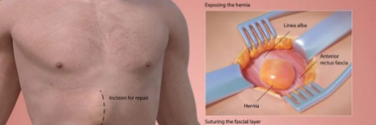 Hernia treatment and surgical repair services by CurePath Health Solution, including specialized guidance for patients with abdominal or groin hernias.