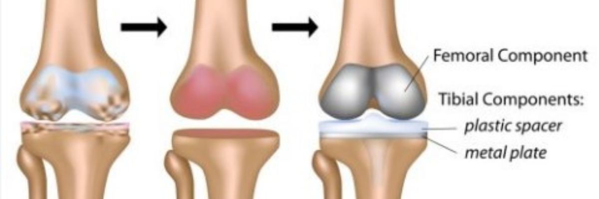 Knee replacement surgery and orthopaedic care services by CurePath Health Solution for patients experiencing chronic knee pain, joint damage, stiffness, and mobility concerns.