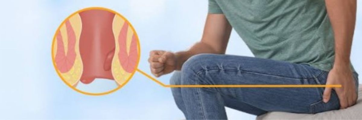 Piles treatment and surgical care services by CurePath Health Solution for patients experiencing haemorrhoids, discomfort, pain, itching, or related symptoms.