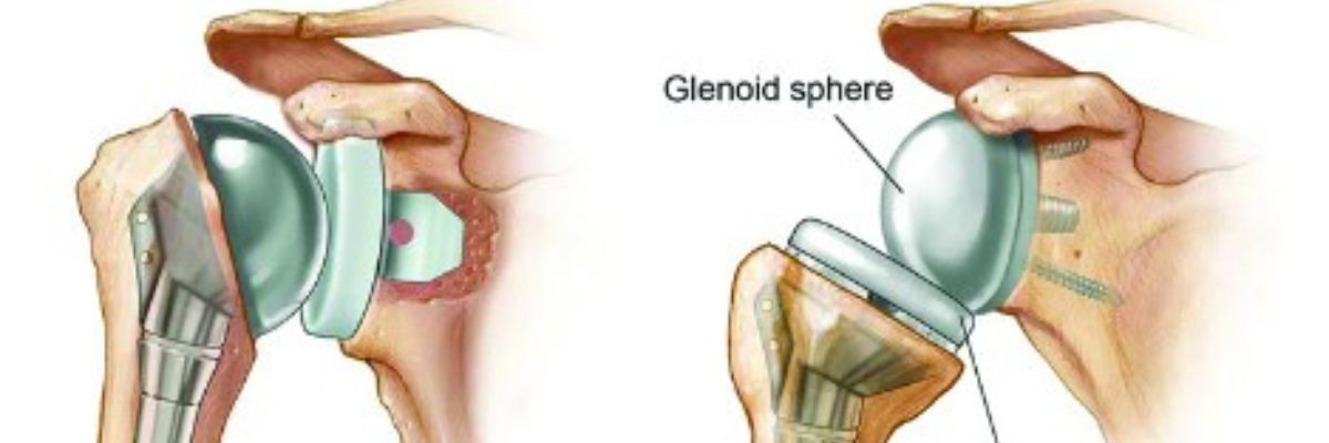 Shoulder replacement surgery and orthopaedic care services by CurePath Health Solution for patients with shoulder joint conditions, pain, and mobility concerns.