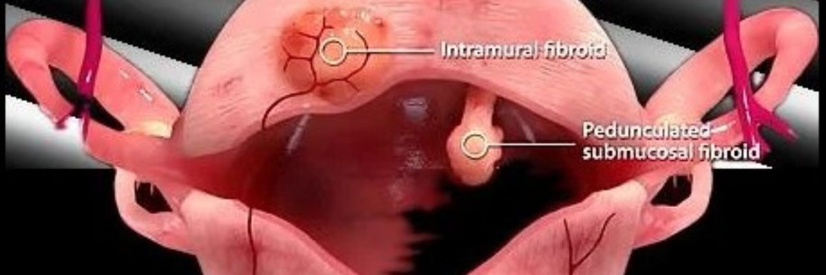 Uterine fibroid symptoms, diagnosis and treatment care at Curepath Health Solution