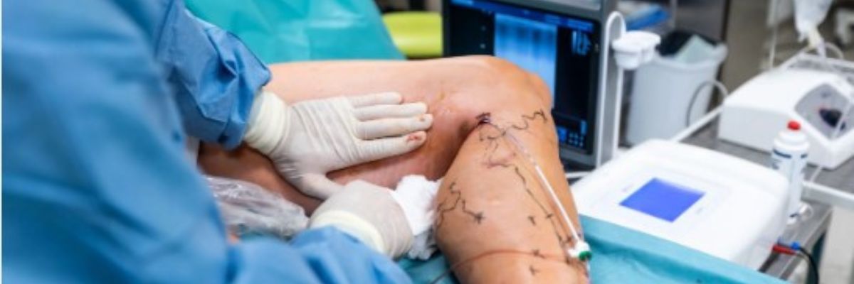 Vascular and endovascular surgery services by CurePath Health Solution for specialized care and treatment guidance for artery, vein, blood vessel, and circulation conditions.